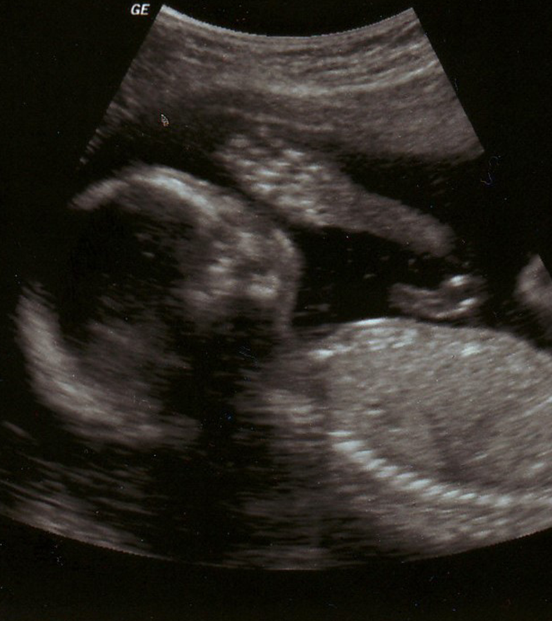 ecografia completa ritraente il feto 